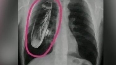 Kenya'da bir hastanın göğüs röntgeninde hamam böceği mi görüldü?